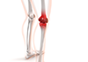 Knee joint ｜ Disease ｜ Knee osteoarthritis / inflammation ｜ Medical equipment / technology ｜ Bone / joint ――Free illustration material ――Medical ｜ Nursing ｜ Hospital ｜ Person